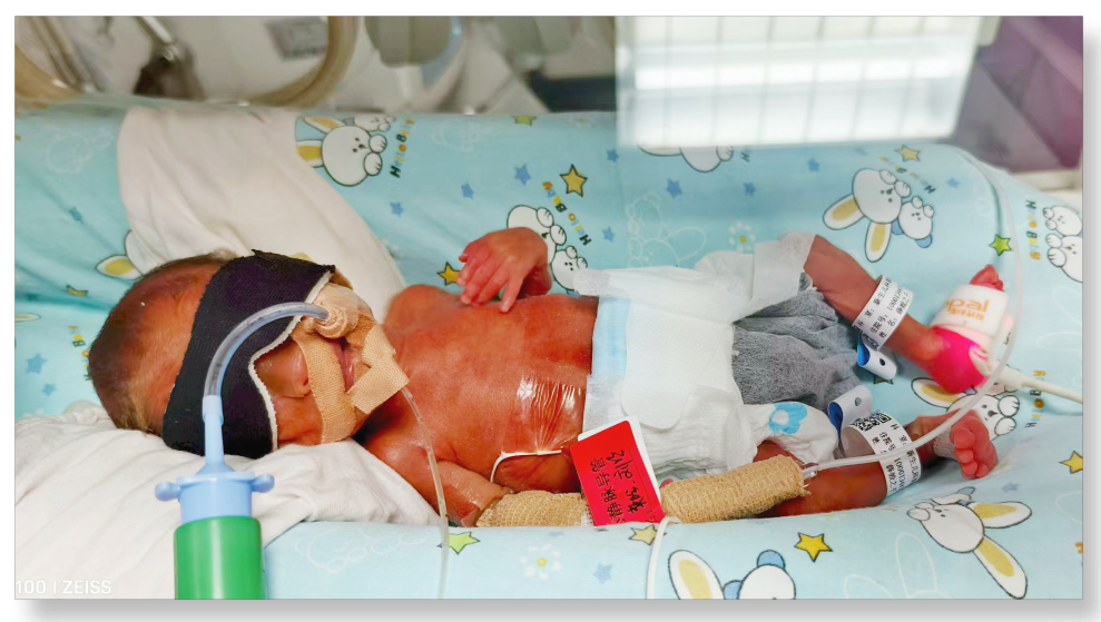 「从未想过放弃！」生死竞速 88 天，西北妇儿成功救下 24 周超早产宝宝